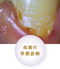 虫歯の早期診断
