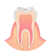 歯の表面に小さな虫歯ができます